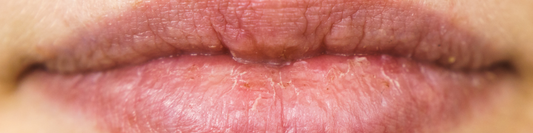 Trockene Lippen pflegen mit natürlichen Inhaltsstoffen